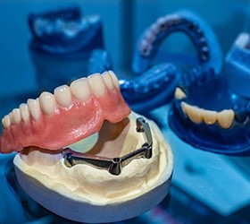Some implant dentures in Bloomfield Hills
