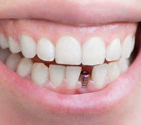 A patient smiling to reveal their surgically placed dental implant