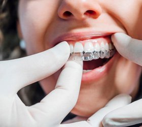 Dentist putting clear aligner on patient's teeth
